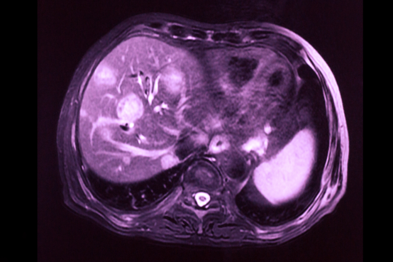 Metastazele Hepatice: Ce Trebuie Să Știi despre Cancerul Hepatic Secundar